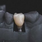 4-step-dental-implant-process