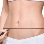 Belly fat come back after tummy tuck