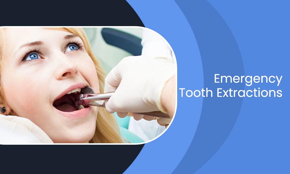 What You Need to Know About Emergency Tooth Extractions